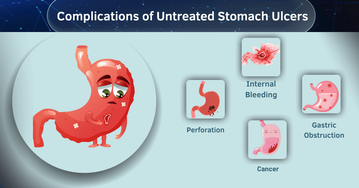 Learn about Complications of Untreated Stomach Ulcers at Bombay Hospital Mumbai