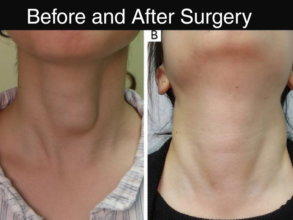 Trans-Oral Endoscopic Thyroid Surgery